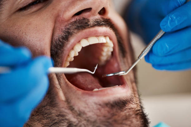 Best Emergency Tooth Extraction in Texarkana, TX